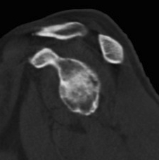 Shoulder Glenoid CT Pear Shaped